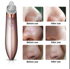 Blackhead Remover Vacuum | Professional Pore Cleaner with 4 Suction Heads