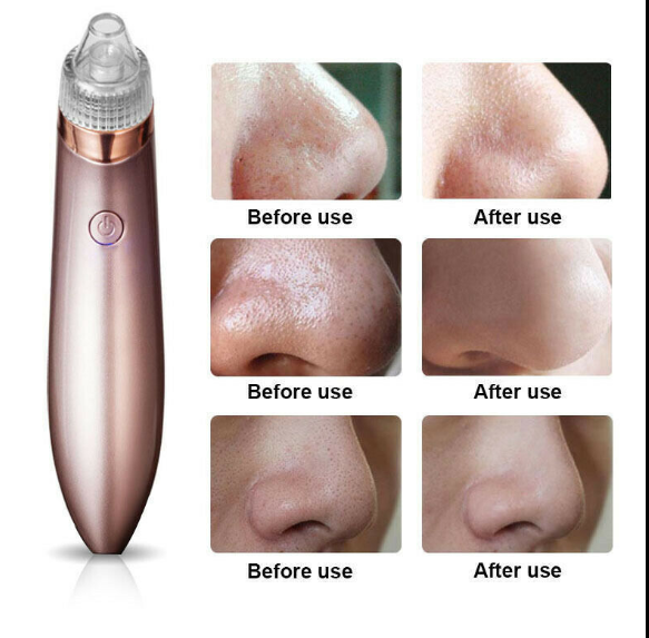 Blackhead Remover Vacuum | Professional Pore Cleaner with 4 Suction Heads